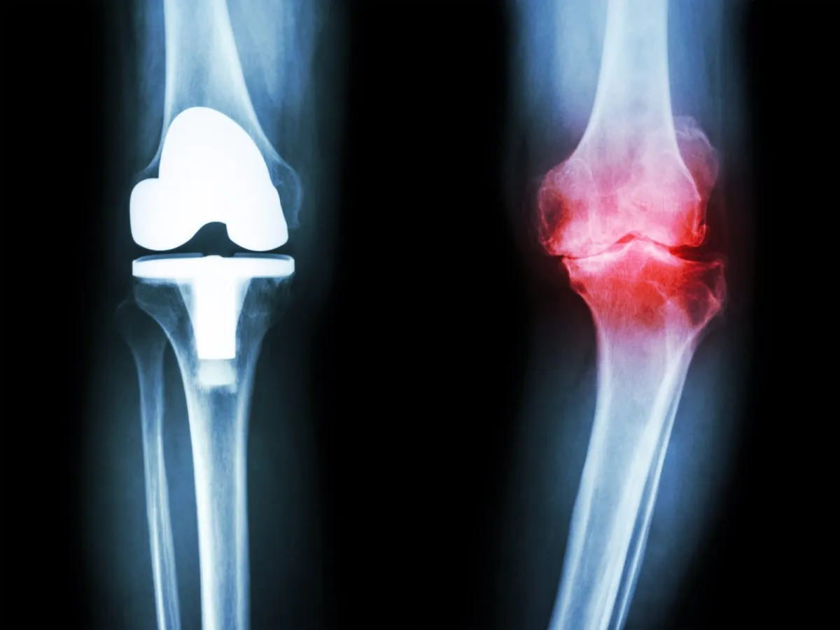Knee osteoarthritis MBST therapy